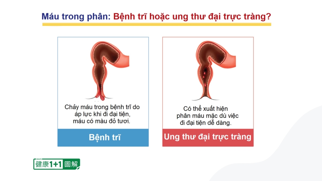 Sự khác nhau giữa bệnh trĩ và ung thư đại trực tràng – khi nào cần đi khám ngay?