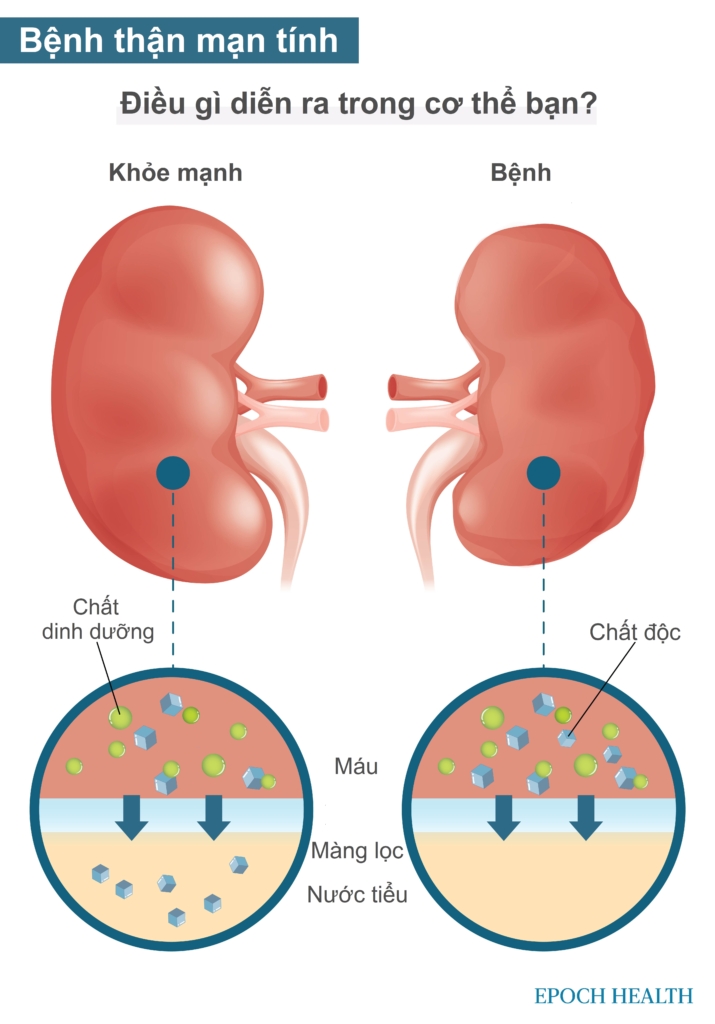 Bệnh thận mạn tính: Triệu chứng, nguyên nhân, phương pháp điều trị và liệu pháp tự nhiên