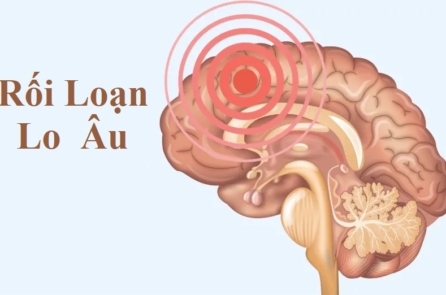 Hướng dẫn cần thiết về Rối loạn lo âu: Triệu chứng, Nguyên nhân, Điều trị và Phương pháp tiếp cận tự nhiên