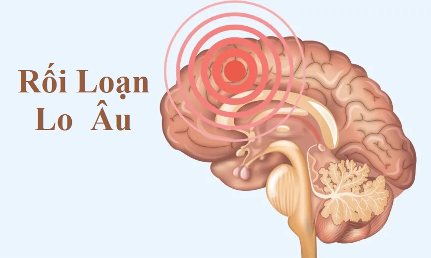 Hướng dẫn cần thiết về Rối loạn lo âu: Triệu chứng, Nguyên nhân, Điều trị và Phương pháp tiếp cận tự nhiên