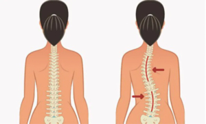Ba động tác đơn giản giúp cải thiện sức khỏe cột sống và chữa vẹo cột sống