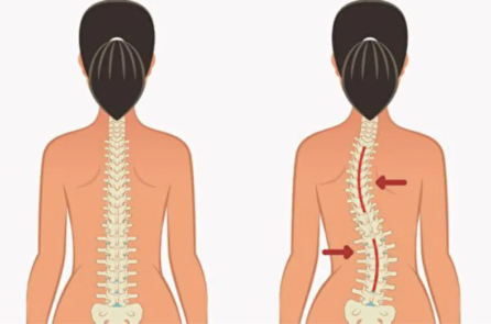 Ba động tác đơn giản giúp cải thiện sức khỏe cột sống và chữa vẹo cột sống