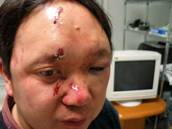 Khuôn mặt của ông Lý Uyên (Peter Yuan Li) bị thương và phải khâu 15 mũi khi ông bị những người đàn ông mang súng đánh đập tại nhà riêng ở Atlanta, Georgia, hôm 08/02/2006. (Ảnh: Minghui.org)