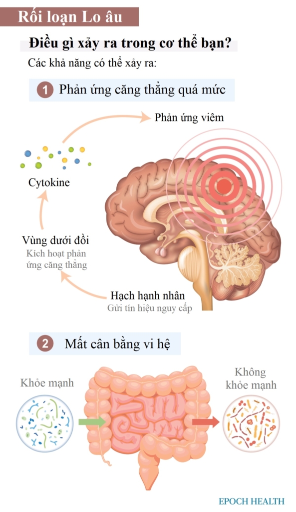 Hướng dẫn cần thiết về Rối loạn lo âu: Triệu chứng, Nguyên nhân, Điều trị và Phương pháp tiếp cận tự nhiên