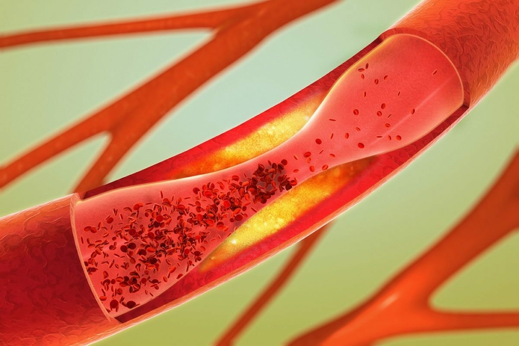 Nồng độ LDL nhỏ-đậm đặc cao trong máu có thể gây ra cục máu đông và xơ vữa động mạch. (Ảnh: Christoph Burgstedt/Shutterstock)