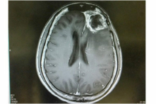Hình ảnh cộng hưởng tử u nguyên bào thần kinh đệm (Ảnh: ShutterStock）
