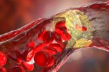 Cholesterol ‘xấu’ có thể không nguy hiểm đến vậy