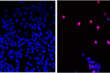 Phân tử nhỏ AOH1996 được phát triển bởi City of Hope nhắm vào một biến thể gây ung thư liên quan đến protein PCNA. Ở dạng đột biến, PCNA đóng vai trò quan trọng trong việc tái bản DNA và sửa chữa các khối u đang phát triển. Hình ảnh cho thấy tế bào ung thư không được điều trị (ảnh bên trái) và tế bào ung thư được điều trị bằng AOH1996 (ảnh bên phải) đang trải qua quá trình chết tế bào theo chương trình (màu tím). (Ảnh: Được phép của City of Hope)