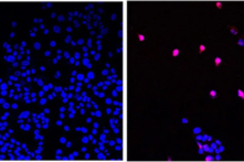 Phân tử nhỏ AOH1996 được phát triển bởi City of Hope nhắm vào một biến thể gây ung thư liên quan đến protein PCNA. Ở dạng đột biến, PCNA đóng vai trò quan trọng trong việc tái bản DNA và sửa chữa các khối u đang phát triển. Hình ảnh cho thấy tế bào ung thư không được điều trị (ảnh bên trái) và tế bào ung thư được điều trị bằng AOH1996 (ảnh bên phải) đang trải qua quá trình chết tế bào theo chương trình (màu tím). (Ảnh: Được phép của City of Hope)