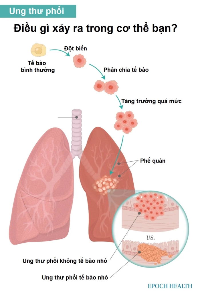 Hướng dẫn cơ bản về ung thư phổi: Triệu chứng, nguyên nhân, điều trị và phương pháp tiếp cận tự nhiên