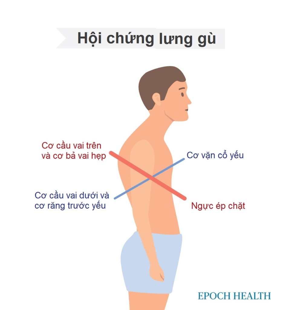 Thói quen ngồi xấu gây gù lưng, 3 bí quyết sửa đơn giản