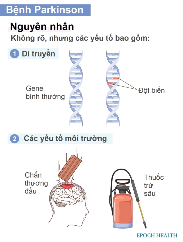 Hướng dẫn cần thiết về bệnh Parkinson: Triệu chứng, nguyên nhân, phương pháp điều trị và liệu pháp tự nhiên