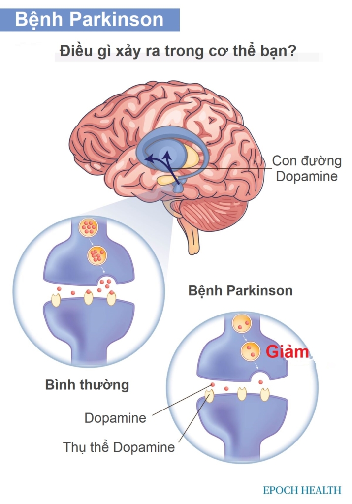 Hướng dẫn cần thiết về bệnh Parkinson: Triệu chứng, nguyên nhân, phương pháp điều trị và liệu pháp tự nhiên