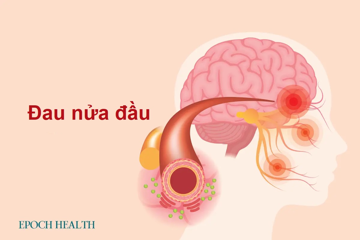 Hướng dẫn cơ bản về đau nửa đầu: Triệu chứng, nguyên nhân, điều trị và phương pháp tiếp cận tự nhiên