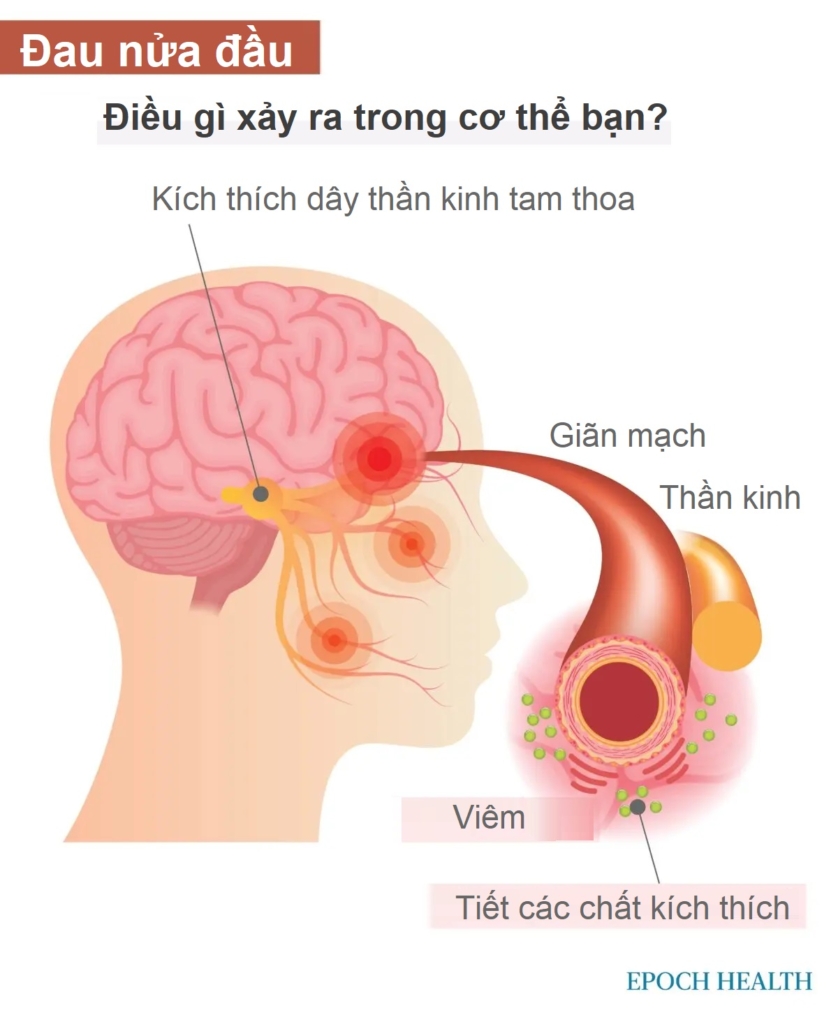 Hướng dẫn cơ bản về đau nửa đầu: Triệu chứng, nguyên nhân, điều trị và phương pháp tiếp cận tự nhiên