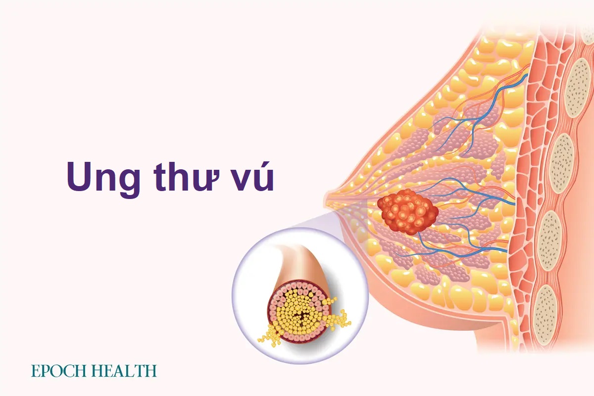 Hướng dẫn cơ bản về ung thư vú: Triệu chứng, nguyên nhân, điều trị và phương pháp tiếp cận tự nhiên