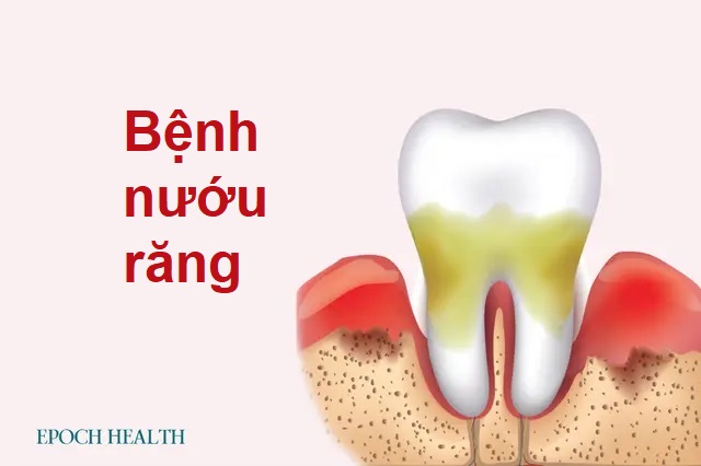 Hướng dẫn cơ bản về bệnh nướu răng: Triệu chứng, nguyên nhân, điều trị và cách tiếp cận tự nhiên