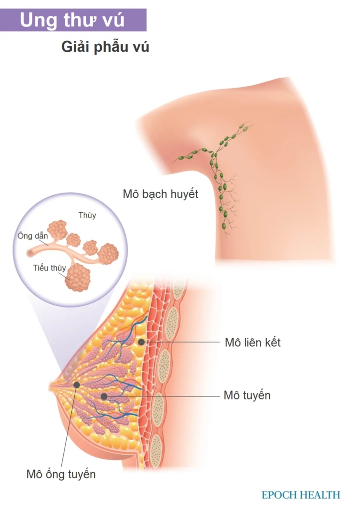 Hướng dẫn cơ bản về ung thư vú: Triệu chứng, nguyên nhân, điều trị và phương pháp tiếp cận tự nhiên