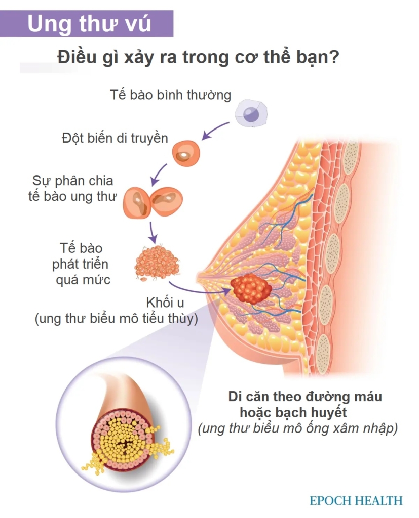 Hướng dẫn cơ bản về ung thư vú: Triệu chứng, nguyên nhân, điều trị và phương pháp tiếp cận tự nhiên