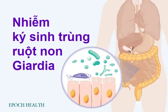 Hướng dẫn cơ bản về bệnh Giardia (nhiễm ký sinh trùng ruột non Giardia): Triệu chứng, nguyên nhân, phương pháp điều trị và cách tiếp cận tự nhiên