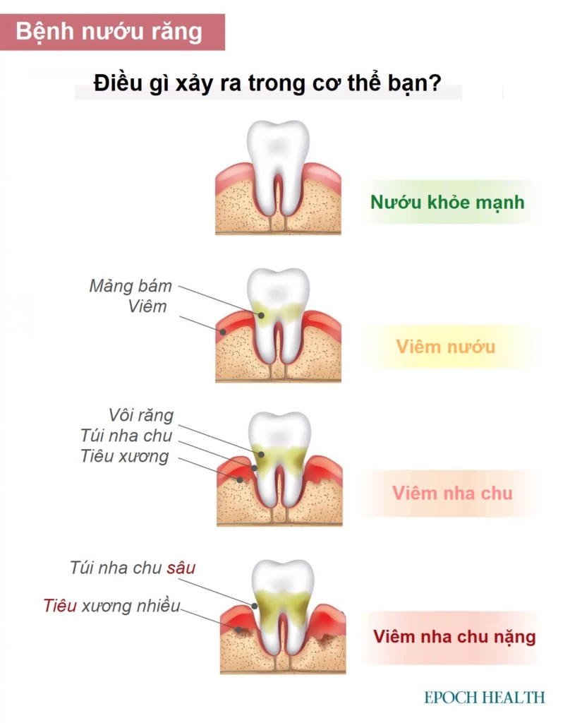 Hướng dẫn cơ bản về bệnh nướu răng: Triệu chứng, nguyên nhân, điều trị và cách tiếp cận tự nhiên