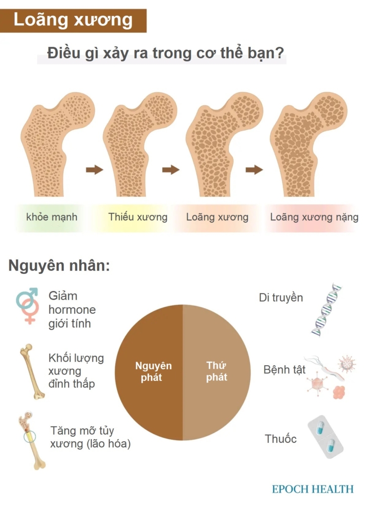 Hướng dẫn cơ bản về loãng xương: Triệu chứng, nguyên nhân, phương pháp điều trị và cách tiếp cận tự nhiên