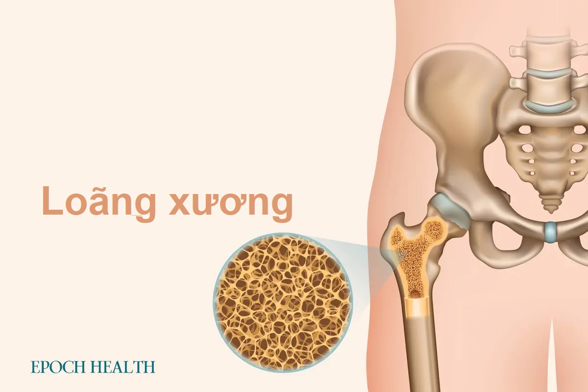 Hướng dẫn cơ bản về loãng xương: Triệu chứng, nguyên nhân, phương pháp điều trị và cách tiếp cận tự nhiên