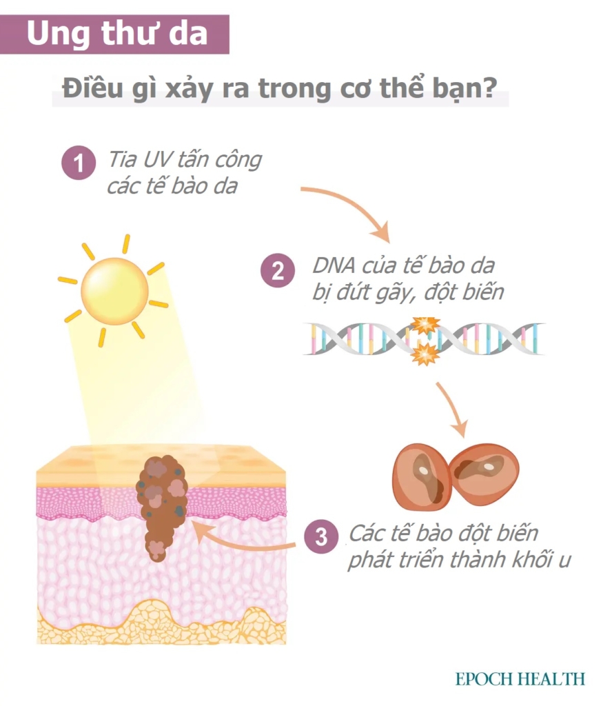 Hướng dẫn cơ bản về ung thư da: Triệu chứng, nguyên nhân, điều trị và giải pháp tự nhiên