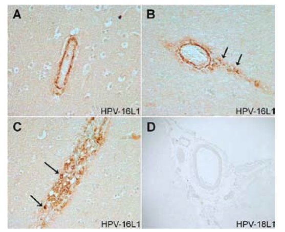 Hình 1 Trường hợp 1. Tạo miễn dịch với mạch máu bằng kháng thể kháng HPV-16L1 (A-C) và kháng thể kháng HPV-18L1 (D). Thành mạch của hai mạch máu nhỏ ở vỏ não vùng giáp ranh cho thấy khả năng miễn dịch dương tính đối với các hạt giống virus (VLP) của protein vỏ chủ yếu tái tổ hợp (L1) ở HPV-16. (Nguồn: Tomljenovic và Shaw 2012. Tập san Quản lý Dược phẩm)