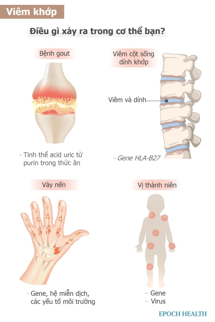 Hướng dẫn cơ bản về bệnh viêm khớp: Triệu chứng, nguyên nhân, điều trị và giải pháp tự nhiên