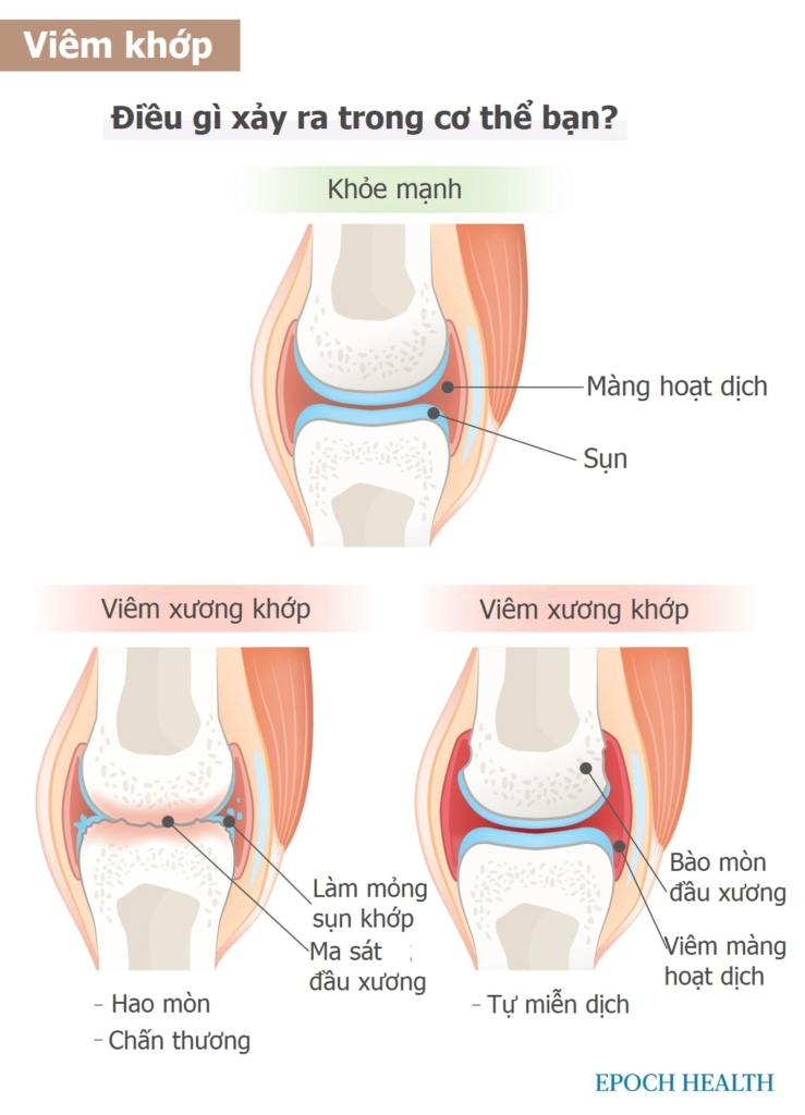 Hướng dẫn cơ bản về bệnh viêm khớp: Triệu chứng, nguyên nhân, điều trị và giải pháp tự nhiên