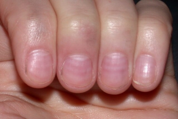 Những đường Muehrcke trên móng tay do hóa trị của một phụ nữ 28 tuổi. (Ảnh: Wikimedia)