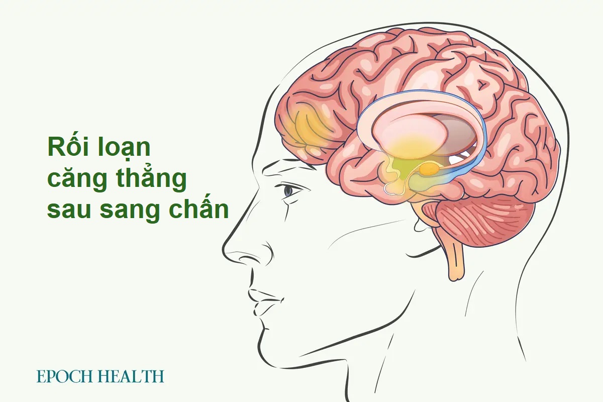 Hướng dẫn cơ bản về Rối loạn căng thẳng sau sang chấn (PTSD): Triệu chứng, nguyên nhân, điều trị và cách tiếp cận tự nhiên