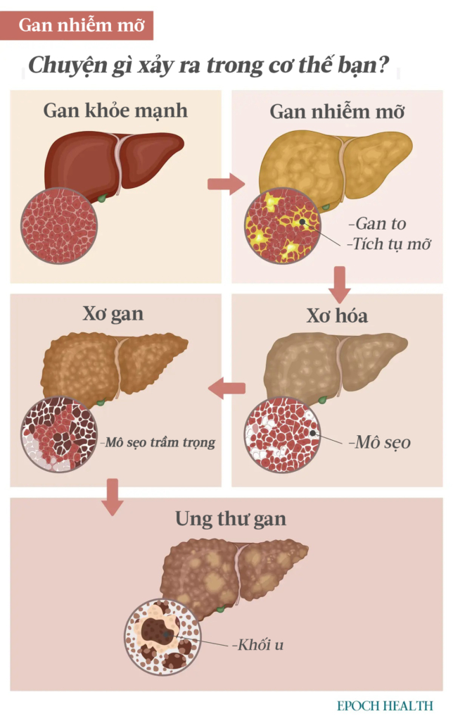 Mặc dù gan nhiễm mỡ không cần được chăm sóc y tế ngay lập tức nhưng tình trạng viêm và sẹo có thể xảy ra nếu căn bệnh tiến triển. Xơ hóa có thể phát triển thành xơ gan không hồi phục, dẫn đến nguy cơ bị suy gan và ung thư. (Minh họa của The Epoch Times,Shutterstock)