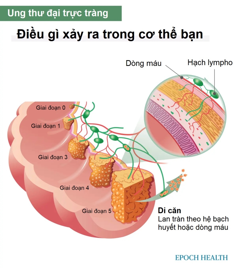 Hướng dẫn cơ bản về ung thư đại trực tràng: Triệu chứng, nguyên nhân, điều trị và cách tiếp cận tự nhiên