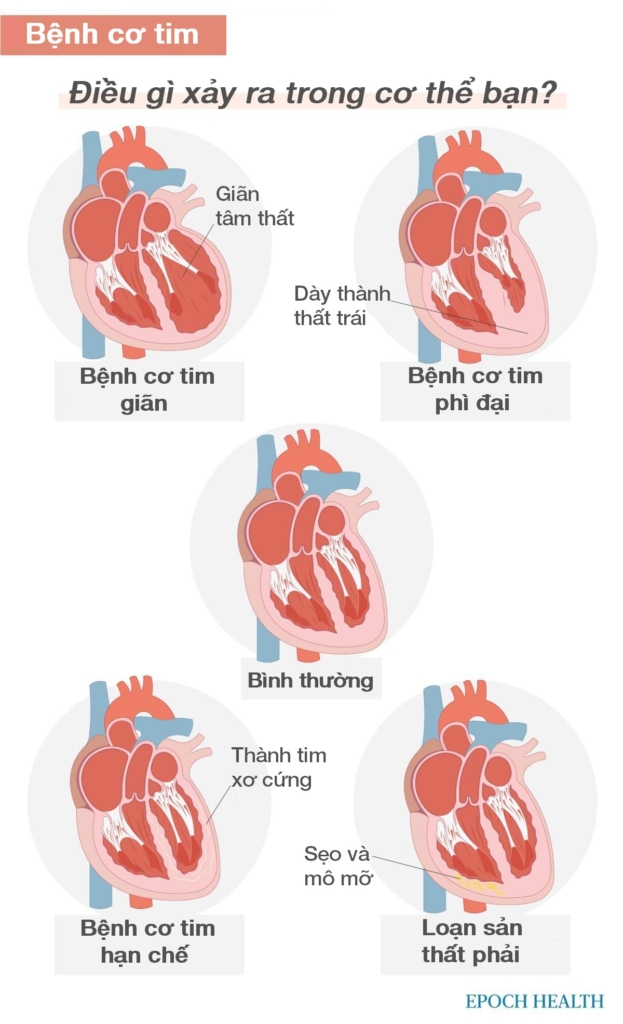 Hướng dẫn cơ bản về bệnh tim: Triệu chứng, nguyên nhân, điều trị và các liệu pháp tự nhiên