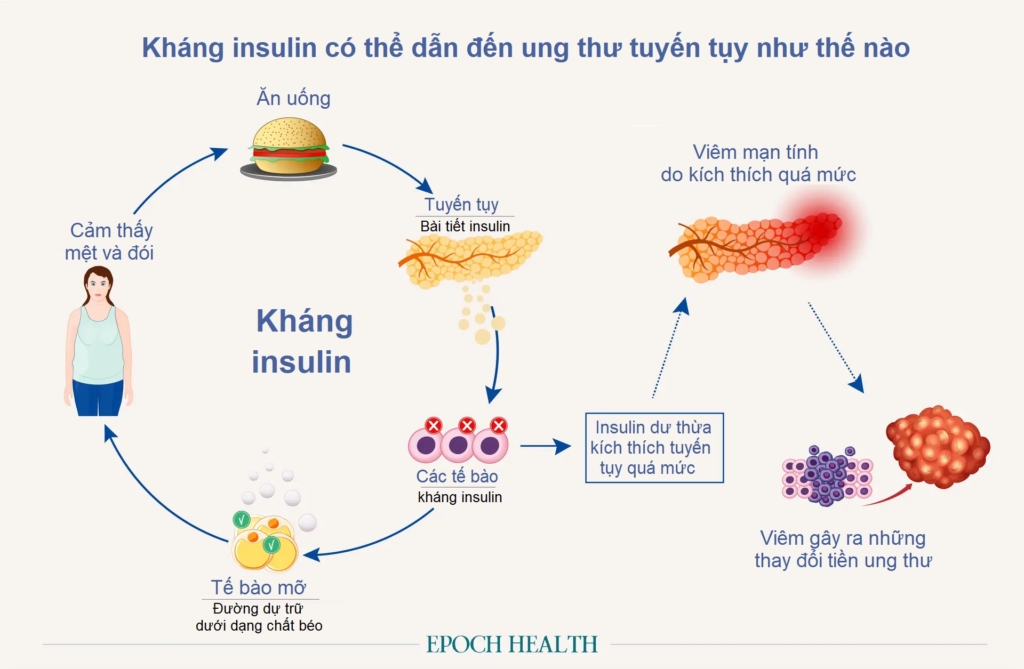 Kháng insulin là nguyên nhân thầm lặng dẫn đến ung thư tuyến tụy