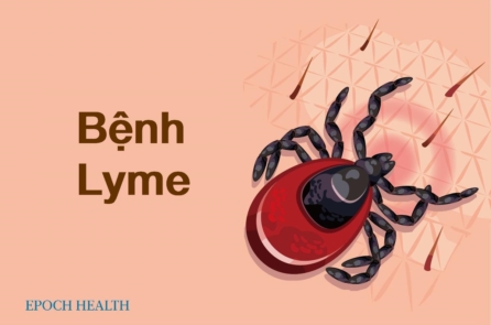 Hướng dẫn cơ bản về bệnh Lyme: Triệu chứng, nguyên nhân, điều trị, và cách tiếp cận tự nhiên