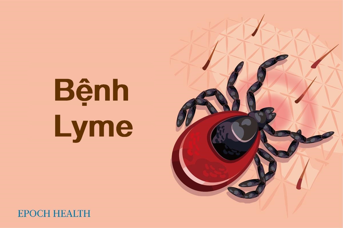 Hướng dẫn cơ bản về bệnh Lyme: Triệu chứng, nguyên nhân, điều trị, và cách tiếp cận tự nhiên