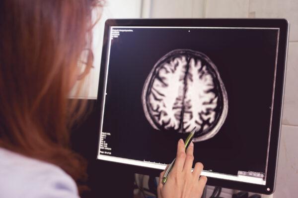 Ảnh chụp MRI não bệnh nhân sa sút trí tuệ cho thấy teo không đối xứng thùy đỉnh trái. (Ảnh: Atthapon Raksthaput/Shutterstock)