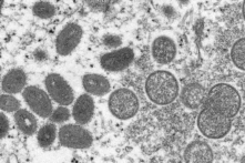 Hình ảnh kính hiển vi điện tử năm 2003 do Trung tâm Kiểm soát và Phòng ngừa Dịch bệnh cung cấp cho thấy các virion đậu mùa khỉ trưởng thành hình bầu dục (trái) và các virion chưa trưởng thành hình cầu (phải) thu được từ một mẫu da người liên quan đến đợt bùng phát chó đồng cỏ năm 2003. (Ảnh: Cynthia S. Goldsmith, Russell Regner/CDC qua AP)