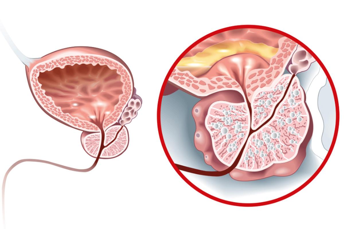 Bảo vệ tuyến tiền liệt với 7 loại thực phẩm không thể thiếu này