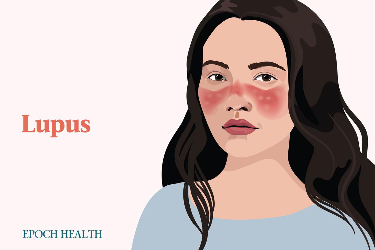 Lupus thường đi kèm với ban cánh bướm đặc biệt trên mặt, nhưng chỉ có khoảng 30% bệnh nhân có triệu chứng này. (Ảnh minh họa: Shutterstock, The Epoch Times)