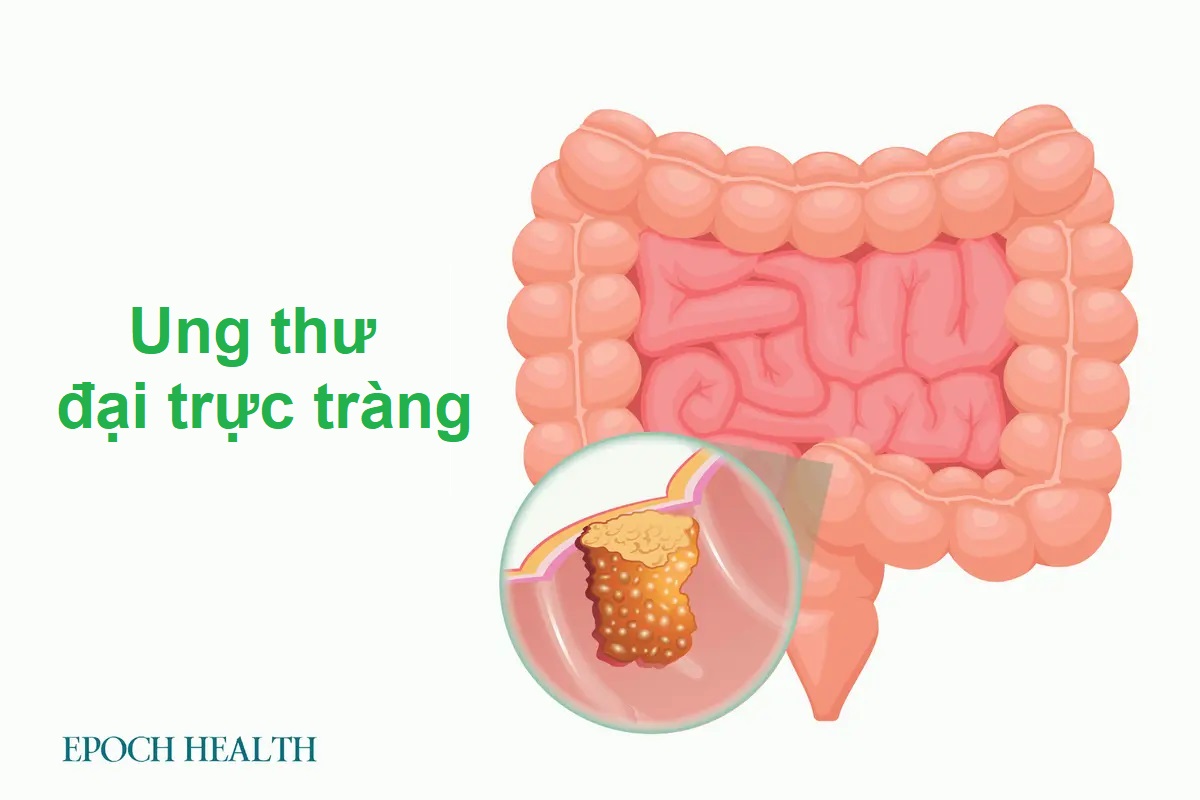 Hướng dẫn cơ bản về ung thư đại trực tràng: Triệu chứng, nguyên nhân, điều trị và cách tiếp cận tự nhiên