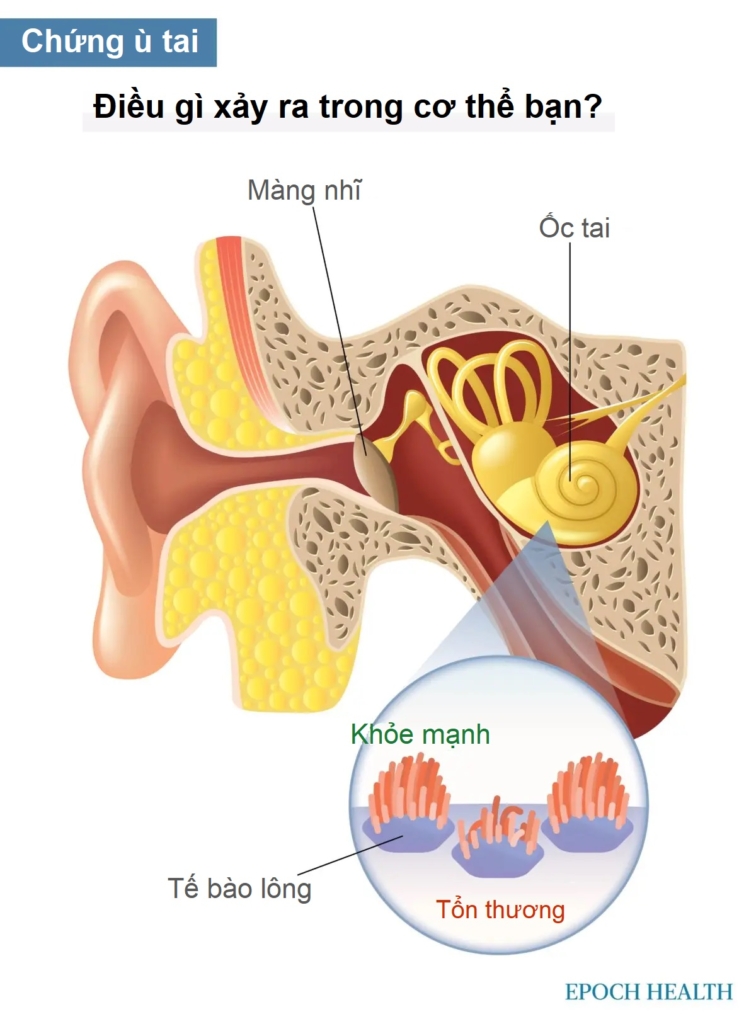 Hướng dẫn cơ bản về chứng ù tai: Triệu chứng, nguyên nhân, phương pháp điều trị và phương pháp tiếp cận tự nhiên