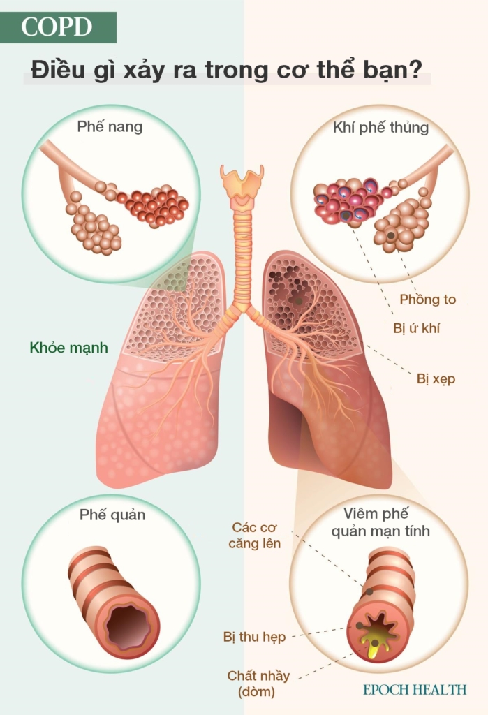 Hướng dẫn cơ bản về bệnh phổi tắc nghẽn mạn tính (COPD): Triệu chứng, nguyên nhân, cách điều trị và các phương pháp tự nhiên