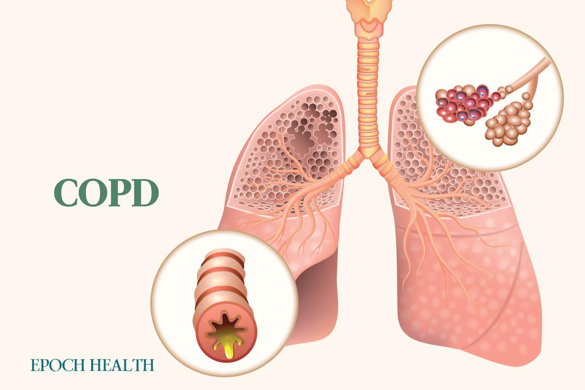 Bệnh phổi tắc nghẽn mạn tính (COPD) thường không được phát hiện ở giai đoạn sớm. (Ảnh minh họa của The Epoch Times, Shutterstock)
