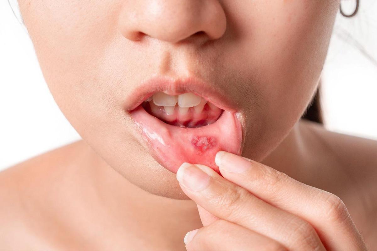 6 mẹo giúp chữa vết lở miệng nhanh hơn