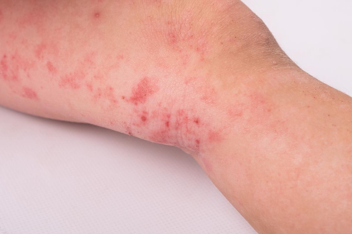 Mối liên quan giữa đường ruột và da là yếu tố then chốt trong bệnh viêm da cơ địa (Eczema)