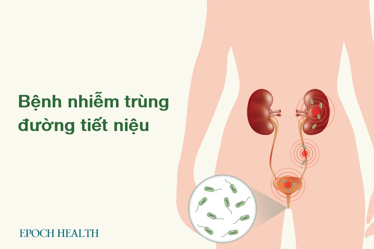 Hướng dẫn cơ bản về bệnh nhiễm trùng đường tiết niệu: Triệu chứng, nguyên nhân, cách điều trị và các phương pháp tự nhiên